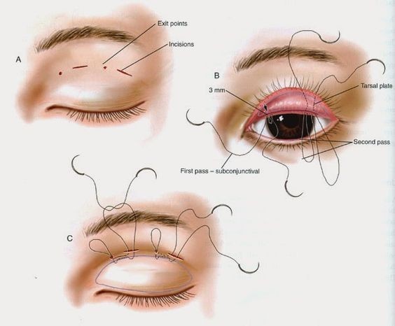 割双眼皮手术步骤图文讲解