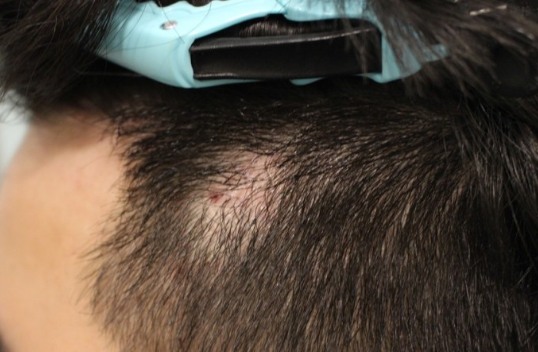 疤痕植发手术具体过程有那几部分?