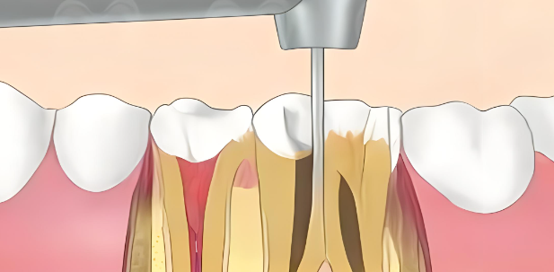 根管治疗使用什么设备修复牙齿?