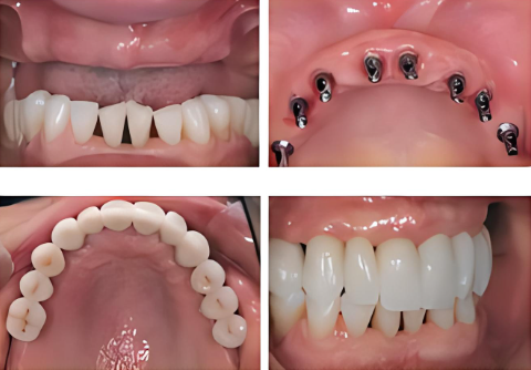 种植牙后引起的不适症状有哪些?