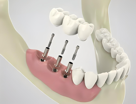 种植牙是否可以与其他牙科治疗结合使用？