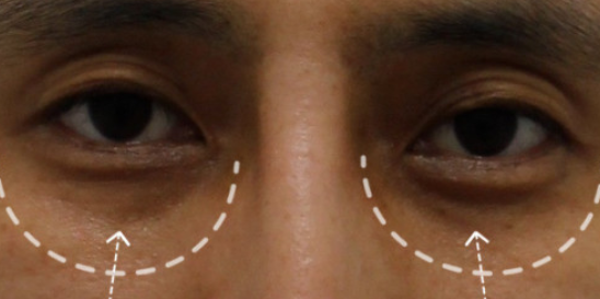 消除黑眼圈手术采用什么设备介绍